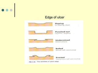 Edge of ulcer
 