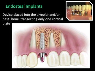 Endosteal Implants
Device placed into the alveolar and/or
basal bone transecting only one cortical
plate
 