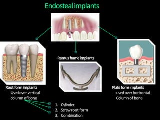 Endostealimplants
Rootformimplants
-Usedover vertical
columnofbone
Plateformimplants
-usedoverhorizontal
Columnof bone
1. Cylinder
2. Screwroot form
3. Combination
Ramusframeimplants
 