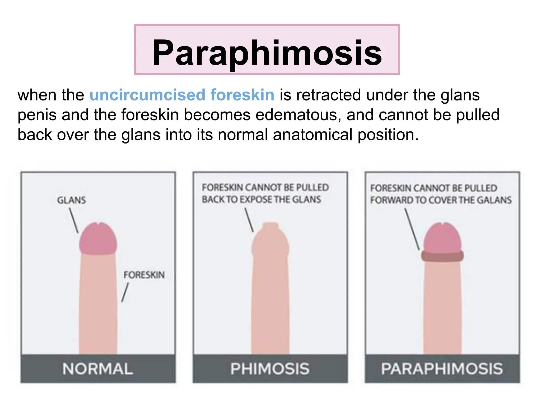 Paraphimosis
when the uncircumcised foreskin is retracted under the glans
penis and the foreskin becomes edematous, and cannot be pulled
back over the glans into its normal anatomical position.
 
