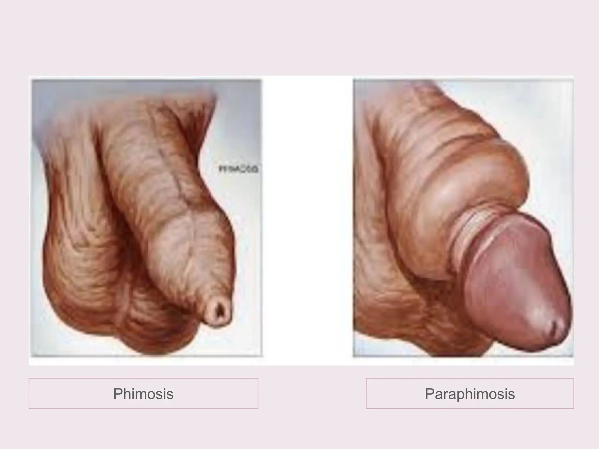 Paraphimosis
Phimosis
 