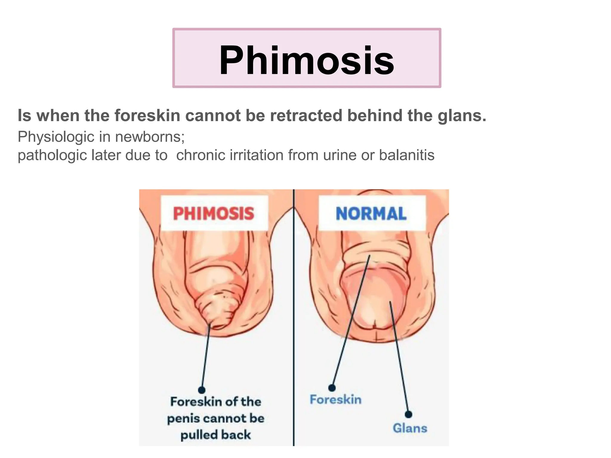 Phimosis
Is when the foreskin cannot be retracted behind the glans.
Physiologic in newborns;
pathologic later due to chronic irritation from urine or balanitis
 
