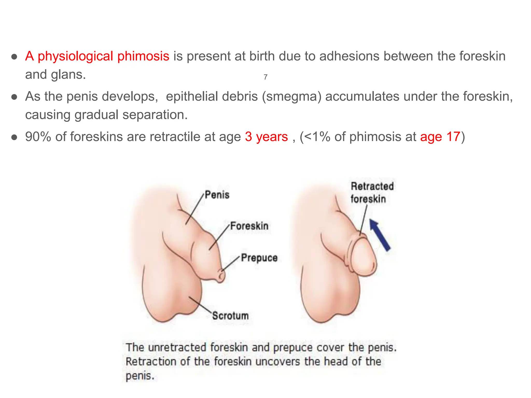 7
● A physiological phimosis is present at birth due to adhesions between the foreskin
and glans.
● As the penis develops, epithelial debris (smegma) accumulates under the foreskin,
causing gradual separation.
● 90% of foreskins are retractile at age 3 years , (<1% of phimosis at age 17)
 