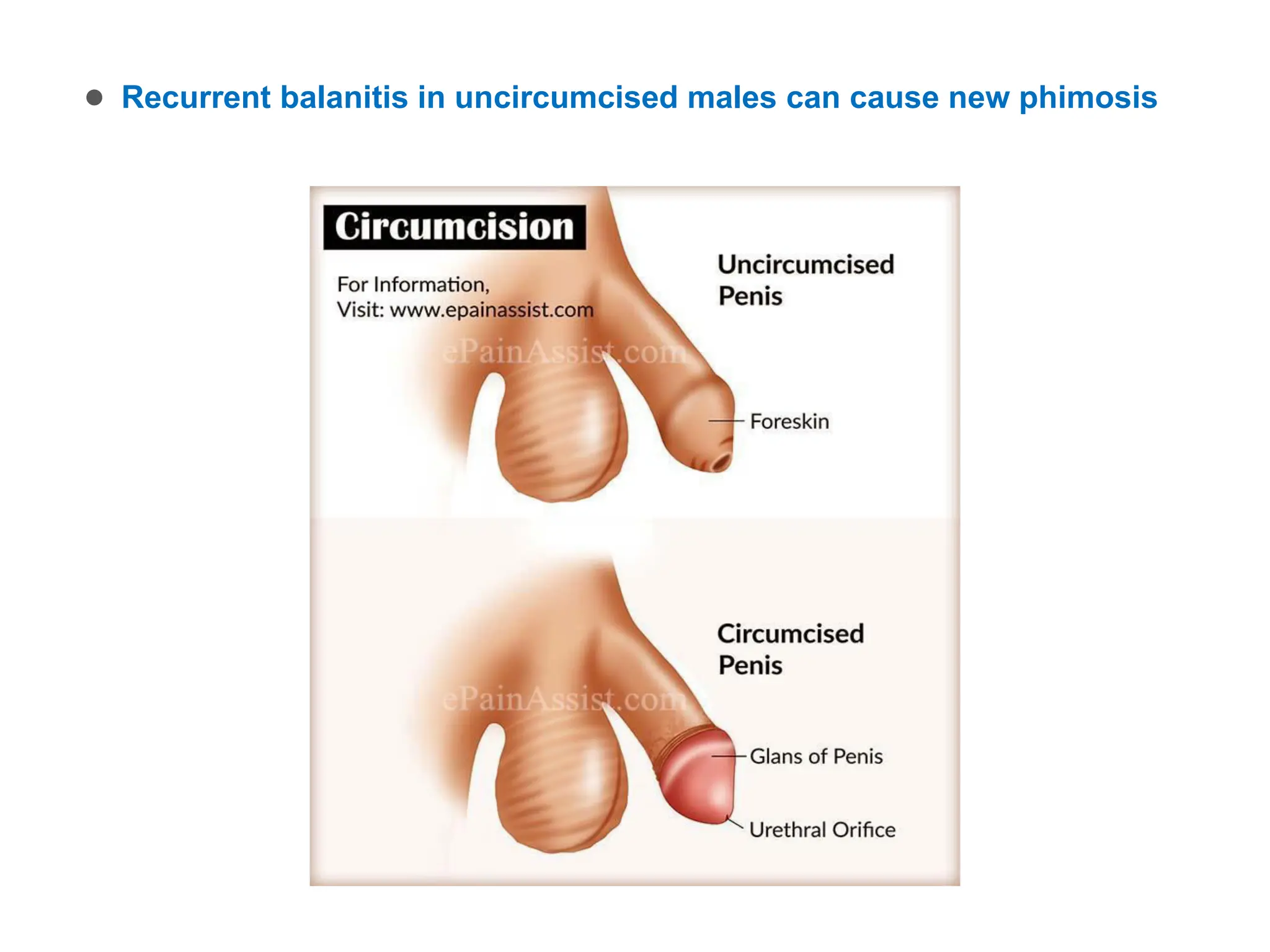 ● Recurrent balanitis in uncircumcised males can cause new phimosis
 
