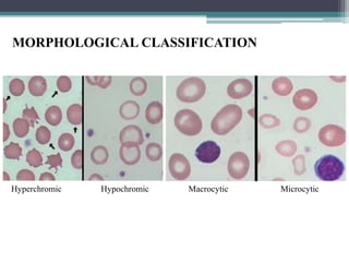 Hyperchromic Definition anemia- oral health | PPTX