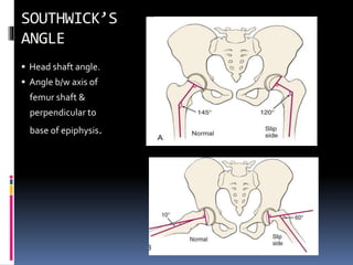  Head shaft angle.
 Angle b/w axis of
femur shaft &
perpendicular to
base of epiphysis.
 