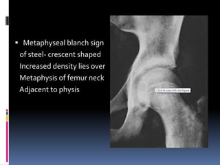  Metaphyseal blanch sign
of steel- crescent shaped
Increased density lies over
Metaphysis of femur neck
Adjacent to physis
 