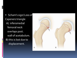  Scham’s sign/ Loss of
Capeners triangle
A) inferomedial
femoral neck
overlaps post.
wall of acetabulum.
B) this is lost due to
displacement.
 