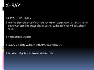  PRESLIP STAGE:
 Minimal slip – absence of normal shoulder on upper aspect of neck & head-
trethowan sign ;line drawn along superior surface of neck will pass above
head.
 Head is sickle shaped.
 Epiphyseal plate widened with streaks of sclerosis.
 Lat view – slightest backward displacement
 