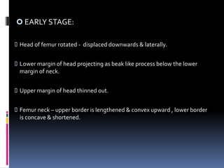  EARLY STAGE:
 Head of femur rotated - displaced downwards & laterally.
 Lower margin of head projecting as beak like process below the lower
margin of neck.
 Upper margin of head thinned out.
 Femur neck – upper border is lengthened & convex upward , lower border
is concave & shortened.
 
