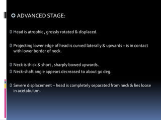  ADVANCED STAGE:
 Head is atrophic , grossly rotated & displaced.
 Projecting lower edge of head is curved laterally & upwards – is in contact
with lower border of neck.
 Neck is thick & short , sharply bowed upwards.
 Neck-shaft angle appears decreased to about 90 deg.
 Severe displacement – head is completely separated from neck & lies loose
in acetabulum.
 