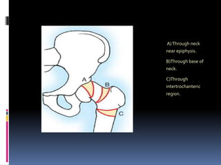 A)Through neck
near epiphysis.
B)Through base of
neck.
C)Through
intertrochanteric
region.
 