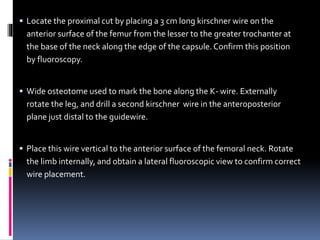  Locate the proximal cut by placing a 3 cm long kirschner wire on the
anterior surface of the femur from the lesser to the greater trochanter at
the base of the neck along the edge of the capsule.Confirm this position
by fluoroscopy.
 Wide osteotome used to mark the bone along the K- wire. Externally
rotate the leg, and drill a second kirschner wire in the anteroposterior
plane just distal to the guidewire.
 Place this wire vertical to the anterior surface of the femoral neck. Rotate
the limb internally, and obtain a lateral fluoroscopic view to confirm correct
wire placement.
 