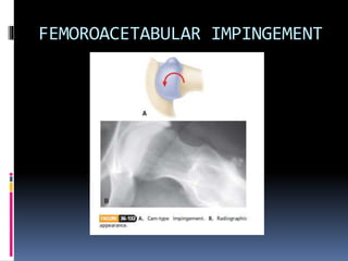 FEMOROACETABULAR IMPINGEMENT
 