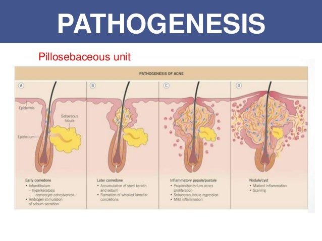 Pathophysiology Of Acne
