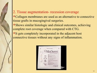 2. Tissue augmentation- recession coverage
Collagen membranes are used as an alternative to connective
tissue grafts in mucogingival surgeries.
Shows similar histologic and clinical outcomes, achieving
complete root coverage when compared with CTG.
It gets completely incorporated in the adjacent host
connective tissues without any signs of inﬂammation.
33
 