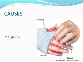 CAUSES
swelling

Tight cast

numbness

Bluish
discoloration

 