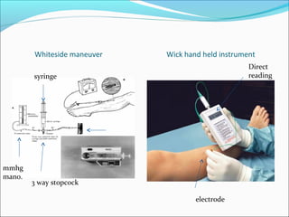 Whiteside maneuver

Wick hand held instrument
Direct
reading

syringe

mmhg
mano.

3 way stopcock
electrode

 