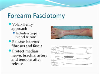 Forearm Fasciotomy
Volar-Henry

approach

Include a carpal

tunnel release

Release lacertus

fibrosus and fascia
Protect median
nerve, brachial artery
and tendons after
release

 