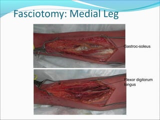 Gastroc-soleus

Flexor digitorum
longus

 