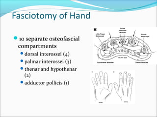 Fasciotomy of Hand
10 separate osteofascial

compartments

dorsal interossei (4)
palmar interossei (3)
thenar and hypothenar

(2)
adductor pollicis (1)

 