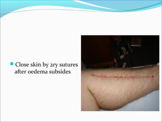 Close skin by 2ry sutures

after oedema subsides

 