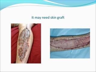 It may need skin graft

 