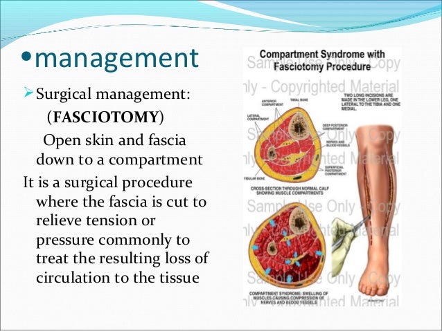 lower extremity compartments fasciotomy lower extremity compartments fasciotomy