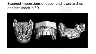 Scanned impressions of upper and lower arches
and bite index in 3D
 