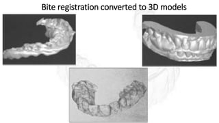 Bite registration converted to 3D models
 