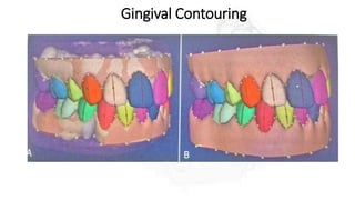 Gingival Contouring
 