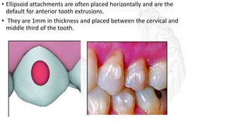 • Ellipsoid attachments are often placed horizontally and are the
default for anterior tooth extrusions.
• They are 1mm in thickness and placed between the cervical and
middle third of the tooth.
 