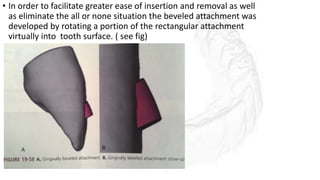 • In order to facilitate greater ease of insertion and removal as well
as eliminate the all or none situation the beveled attachment was
developed by rotating a portion of the rectangular attachment
virtually into tooth surface. ( see fig)
 
