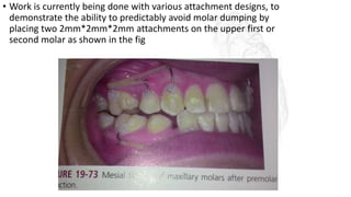 • Work is currently being done with various attachment designs, to
demonstrate the ability to predictably avoid molar dumping by
placing two 2mm*2mm*2mm attachments on the upper first or
second molar as shown in the fig
 