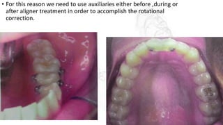 • For this reason we need to use auxiliaries either before ,during or
after aligner treatment in order to accomplish the rotational
correction.
 