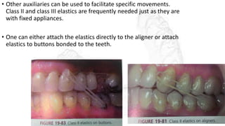 • Other auxiliaries can be used to facilitate specific movements.
Class II and class III elastics are frequently needed just as they are
with fixed appliances.
• One can either attach the elastics directly to the aligner or attach
elastics to buttons bonded to the teeth.
 