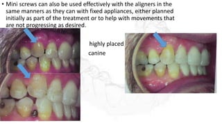 • Mini screws can also be used effectively with the aligners in the
same manners as they can with fixed appliances, either planned
initially as part of the treatment or to help with movements that
are not progressing as desired.
• H highly placed
• canine
 