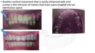 • Another vertical movement that is easily enhanced with mini
screws is the intrusion of molars that have supra erupted into an
edentulous space.
 