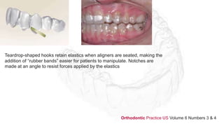Teardrop-shaped hooks retain elastics when aligners are seated, making the
addition of “rubber bands” easier for patients to manipulate. Notches are
made at an angle to resist forces applied by the elastics
Orthodontic Practice US Volume 6 Numbers 3 & 4
 