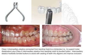 Class I intramaxillary elastics connected from teardrop hook to a miniscrew (i.e., to support molar
distalization) plus Class II intermaxillary elastics from teardrop notch to bonded button.. Intermaxillary
elastics hookedto bonded buttons to assist with seating of teeth into aligners and improve occlusion
 