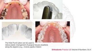 The Hole Punch pliers can be used to
relieve plastic impingement of gingival tissues anywhere
along the aligners (e.g., incisive papilla irritation
Orthodontic Practice US Volume 6 Numbers 3 & 4
 