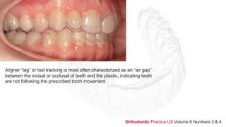 Aligner “lag” or lost tracking is most often characterized as an “air gap”
between the incisal or occlusal of teeth and the plastic, indicating teeth
are not following the prescribed tooth movement
Orthodontic Practice US Volume 6 Numbers 3 & 4
 