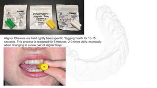Aligner Chewies are held tightly been specific “lagging” teeth for 10-15
seconds. This process is repeated for 5 minutes, 2-3 times daily, especially
when changing to a new pair of aligner trays
 