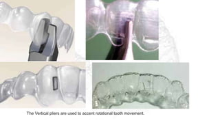 The Vertical pliers are used to accent rotational tooth movement.
 