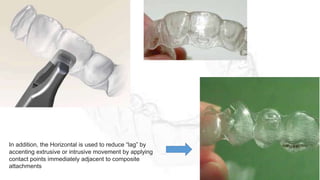 In addition, the Horizontal is used to reduce “lag” by
accenting extrusive or intrusive movement by applying
contact points immediately adjacent to composite
attachments
 