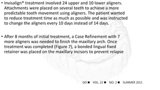 • Invisalign® treatment involved 24 upper and 10 lower aligners.
Attachments were placed on several teeth to achieve a more
predictable tooth movement using aligners. The patient wanted
to reduce treatment time as much as possible and was instructed
to change the aligners every 10 days instead of 14 days.
• After 8 months of initial treatment, a Case Refinement with 7
more aligners was needed to finish the maxillary arch. Once
treatment was completed (Figure 7), a bonded lingual fixed
retainer was placed on the maxillary incisors to prevent relapse
IJO  VOL. 22  NO. 2  SUMMER 2011
 