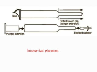 Intracervical placement
 