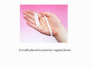 Cervidil placed in posterior vaginal fornix
 