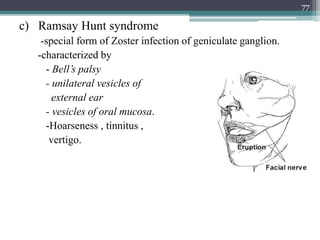 c) Ramsay Hunt syndrome
-special form of Zoster infection of geniculate ganglion.
-characterized by
- Bell’s palsy
- unilateral vesicles of
external ear
- vesicles of oral mucosa.
-Hoarseness , tinnitus ,
vertigo.
77
 