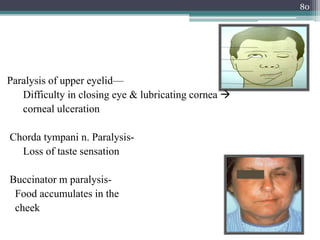 Paralysis of upper eyelid—
Difficulty in closing eye & lubricating cornea 
corneal ulceration
Chorda tympani n. Paralysis-
Loss of taste sensation
Buccinator m paralysis-
Food accumulates in the
cheek
80
 